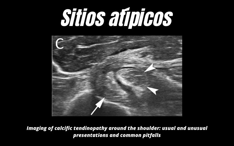 Sitio atipico calcificacion Ecografia 8.png